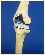 Total Knee Arthroplasty - Step 8