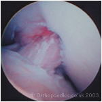 Arthroscopic image of an ACL