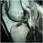 MRI of a torn anterior cruciate ligament (ACL)