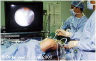Mr David Johnson operating using arthroscopic 'keyhole' surgery