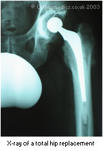 x-ray image of the hip