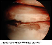 Arthroscopic image of knee arthritis