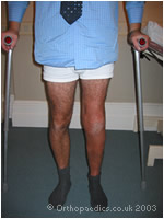 Walking just after total knee replacement at the Bristol Nuffield Hospital