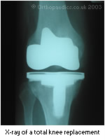X-ray of Profix total knee replacement 