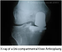 X-ray of Uni-compartmental Knee Arthroplasty