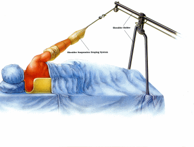 The patient position for shoulder arthroscopy with traction applied to the arm