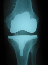 knee implant x-ray